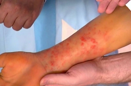 12 die on deadliest day of dengue outbreak in Bangladesh