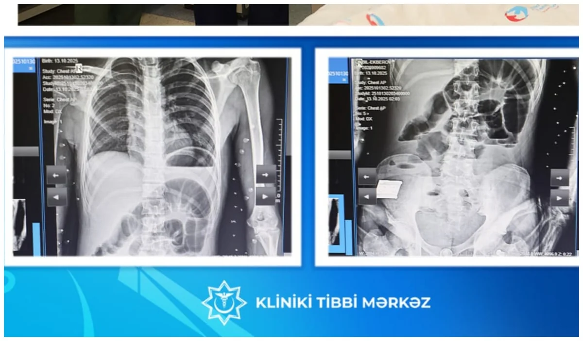 Bakıda 17 yaşlı yeniyetmənin bağırsağından taxta çıxarılıb
