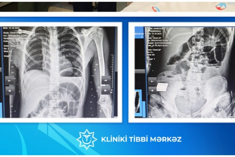Bakıda 17 yaşlı yeniyetmənin bağırsağından taxta çıxarılıb