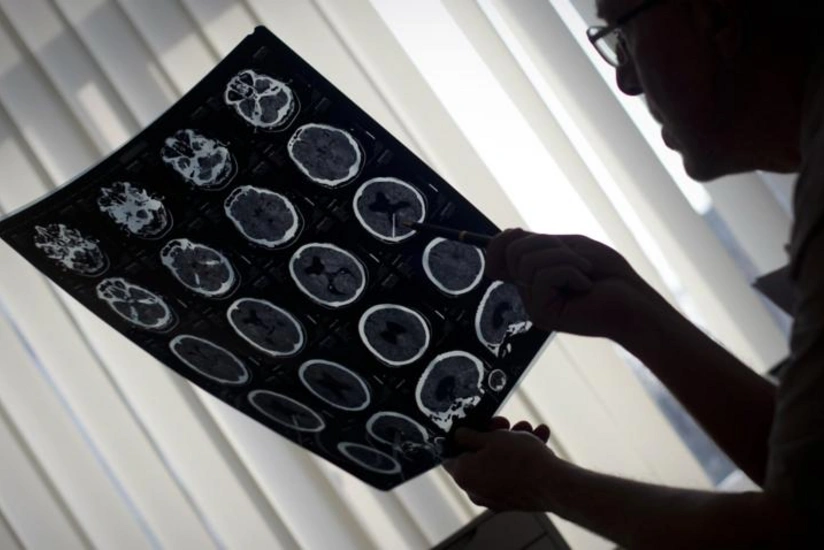Создана ультразвуковая терапия для защиты мозга от последствий инсультов