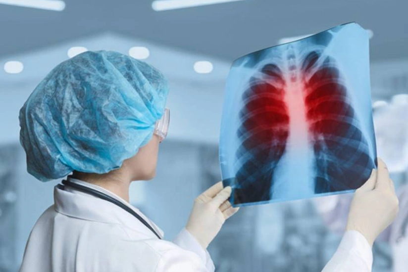 Tuberculosis incidence declines in Azerbaijan in 2025