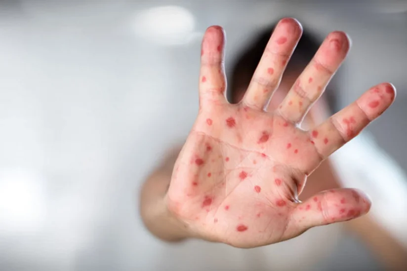 Azerbaijan says measles, chickenpox situation remains stable