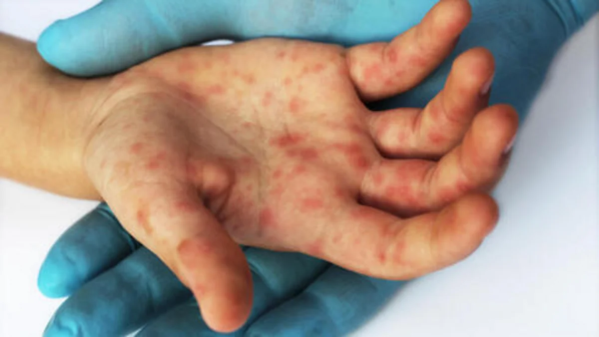 Pensilvaniyada qızılca epidemiyası qeydə alınıb
