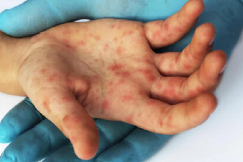 Pensilvaniyada qızılca epidemiyası qeydə alınıb