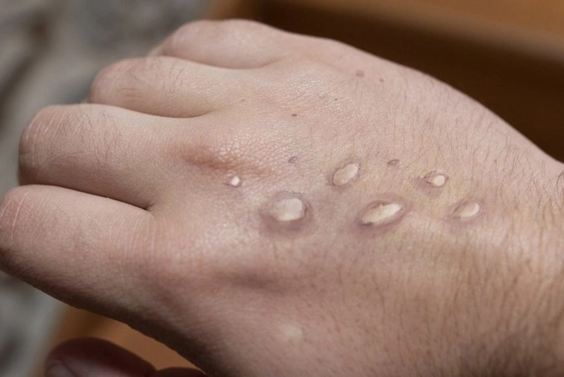 Rusiyada meymunçiçəyi virusuna iki yoluxma qeydə alınıb