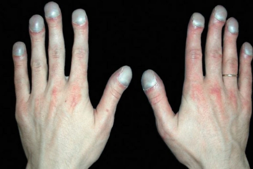 Study reveals unexpected harbinger of cancer