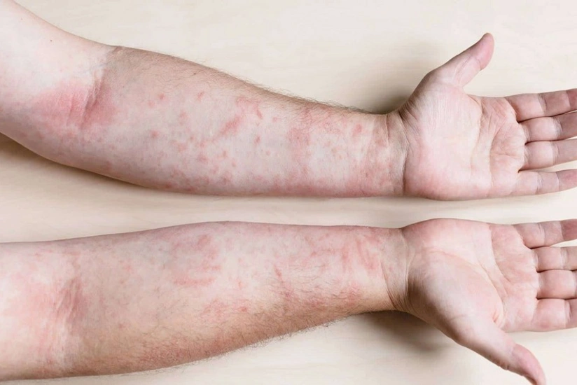 Son on gündə Cəlilabadda 83 nəfər qızılcaya yoluxub 