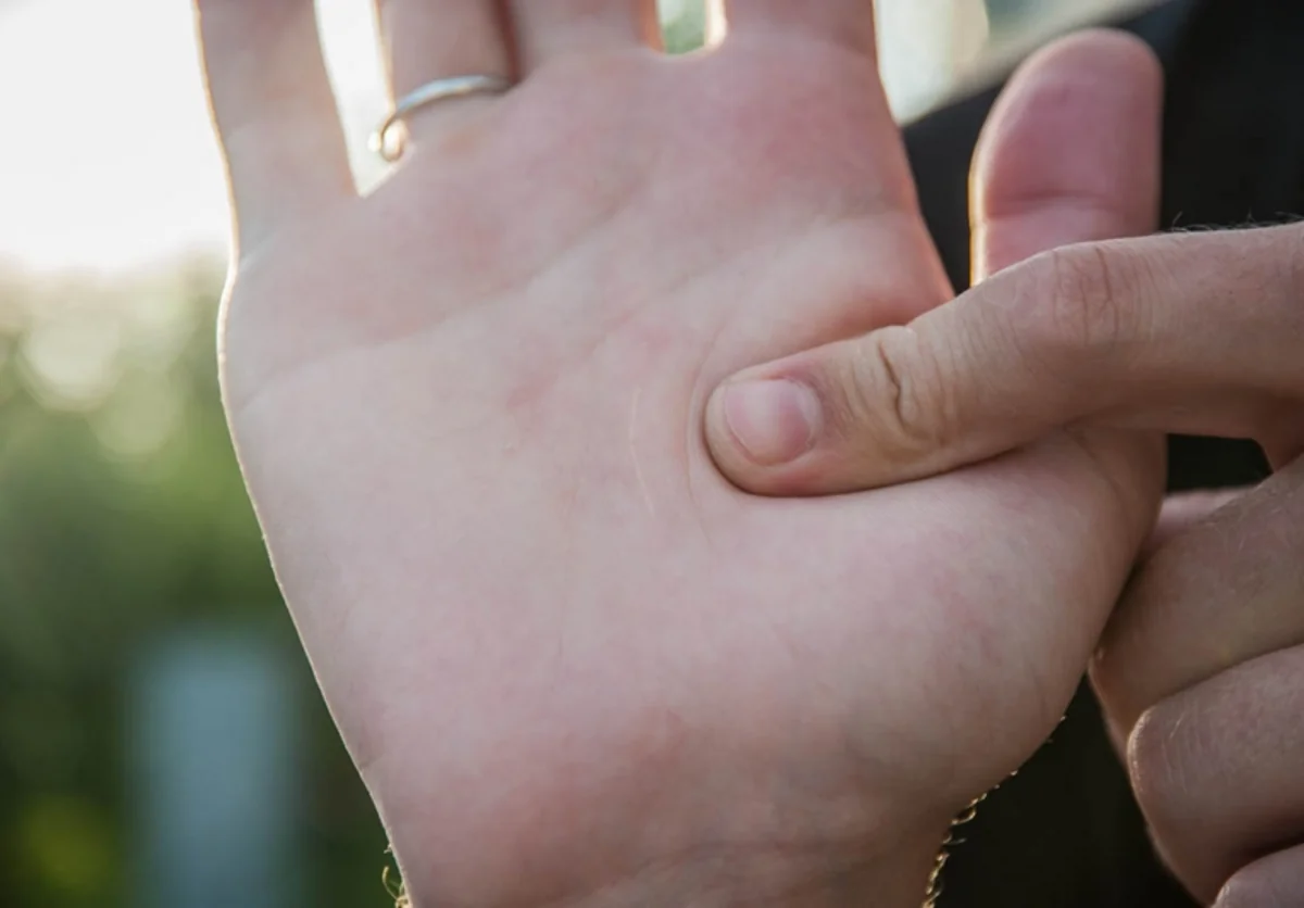 Scars on palms may be symptom of fatal disease