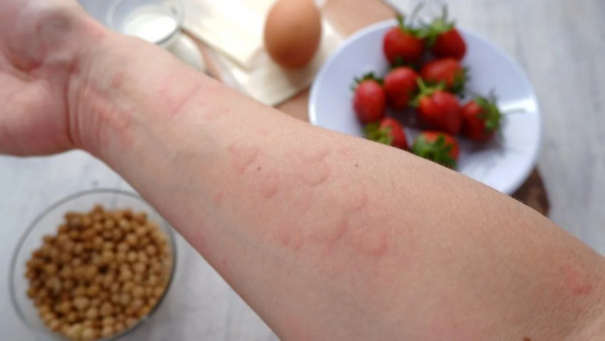 Allerqoloq qida allergiyası ilə bağlı valideynlərə çağırış edib: həkimə müraciət edin