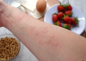 Allerqoloq qida allergiyası ilə bağlı valideynlərə çağırış edib: həkimə müraciət edin