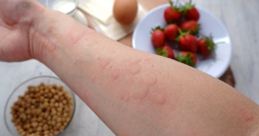 Allerqoloq qida allergiyası ilə bağlı valideynlərə çağırış edib: həkimə müraciət edin