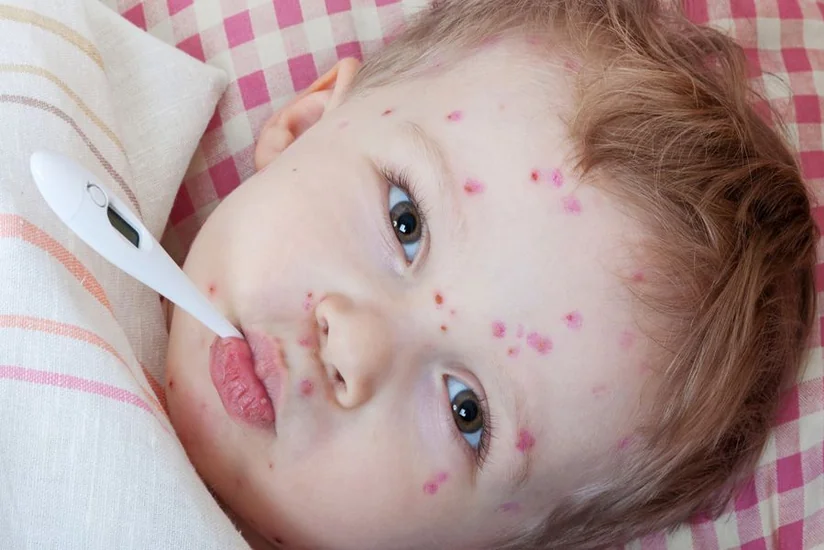 Health Minister signs decree on measures to prevent measles