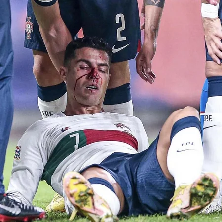 Ronaldu rəqib qapıçı ilə toqquşmadan sonra ciddi xəsarət alıb