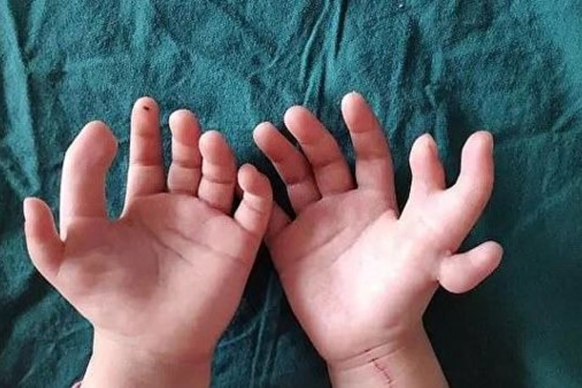 Çində 14 barmağı olan uşaq əməliyyat olunub