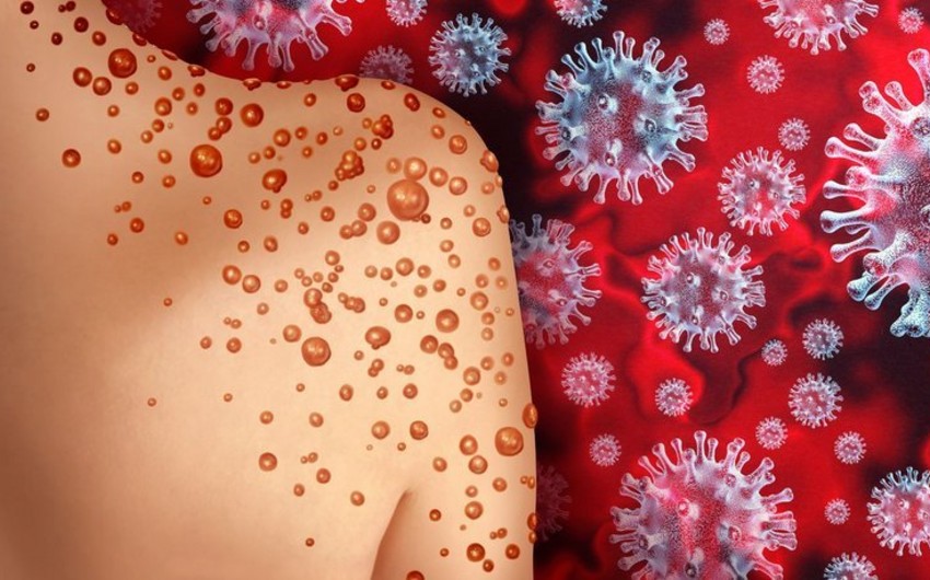 Azerbaijan reports first case of monkeypox