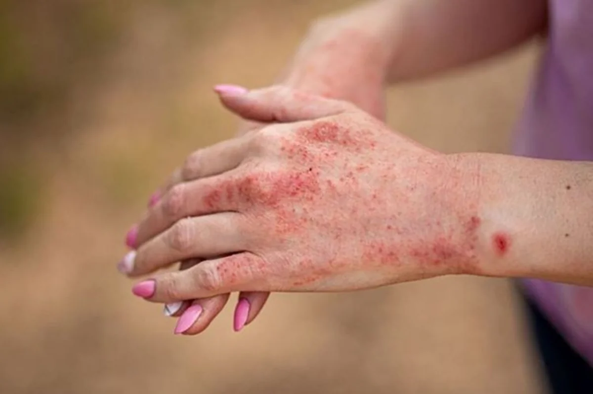 İnstitut qızılca ilə bağlı valideynlərə çağırış edib