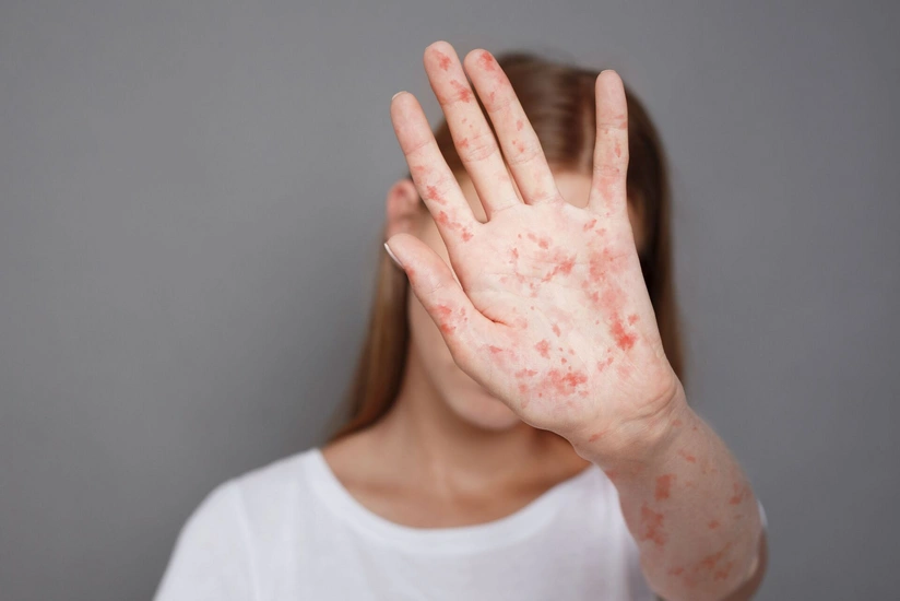 WHO: Measles infection has increased sharply in Turkic world over past year