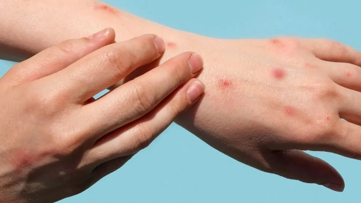 Rusiyada meymunçiçəyini aşkar edən test hazırlanıb