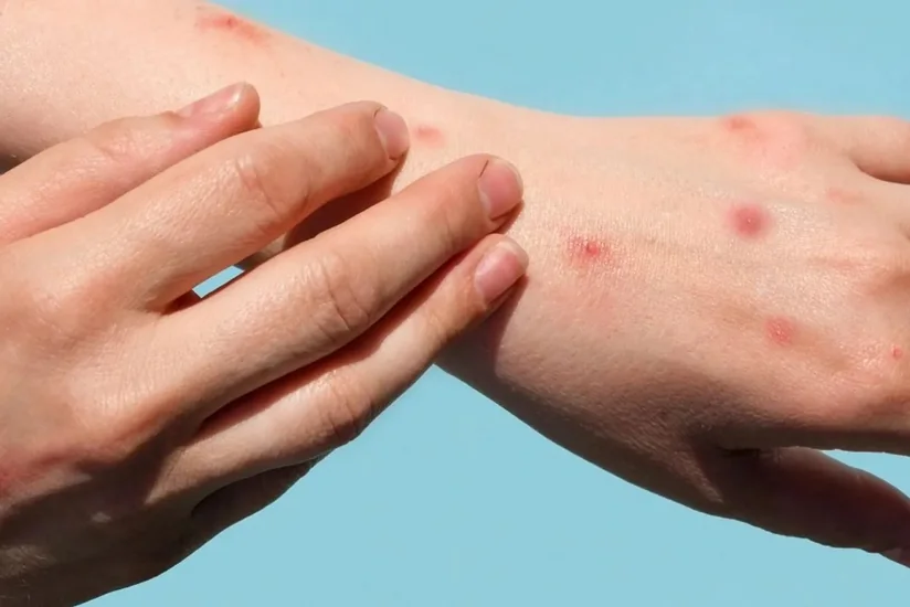 В Турции зафиксирован первый случай заражения оспой обезьян