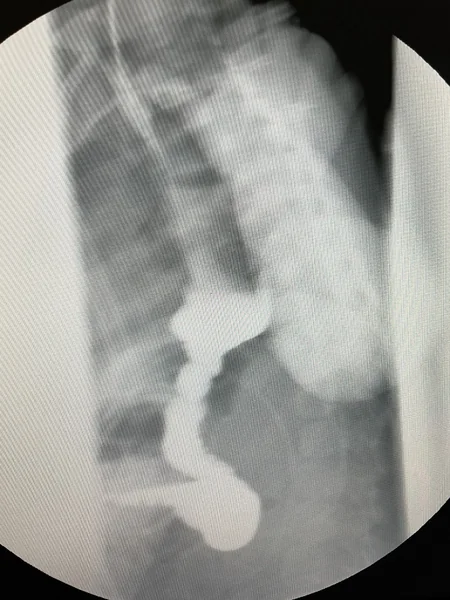 Esophageal replacement surgery performed in Azerbaijan for first time