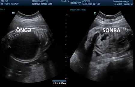 Baby operated inside mother's womb in Azerbaijan