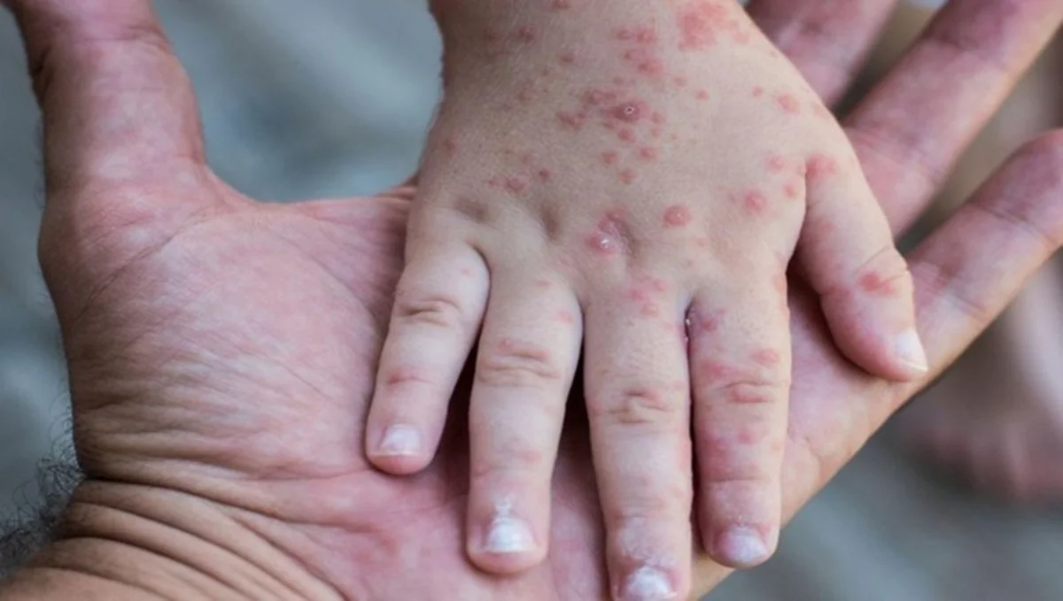 One dead, two infected after meningococcal disease outbreak declared in Toronto