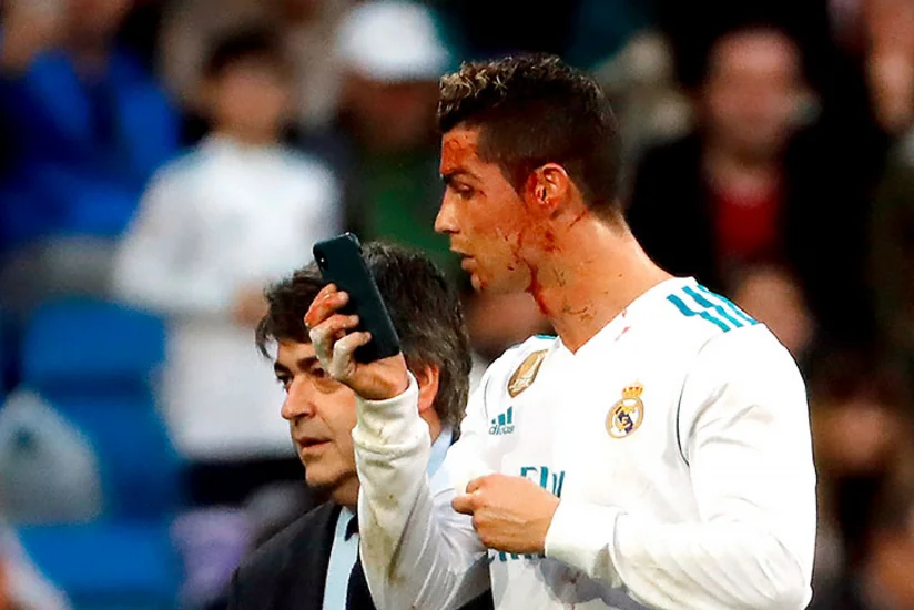 Futbol üzrə İspaniya çempionatının oyununda Ronaldunun qaşı yarılıb