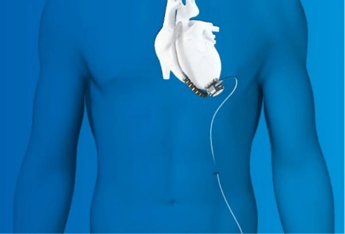 Azerbaijani doctor implants artificial heart to patient