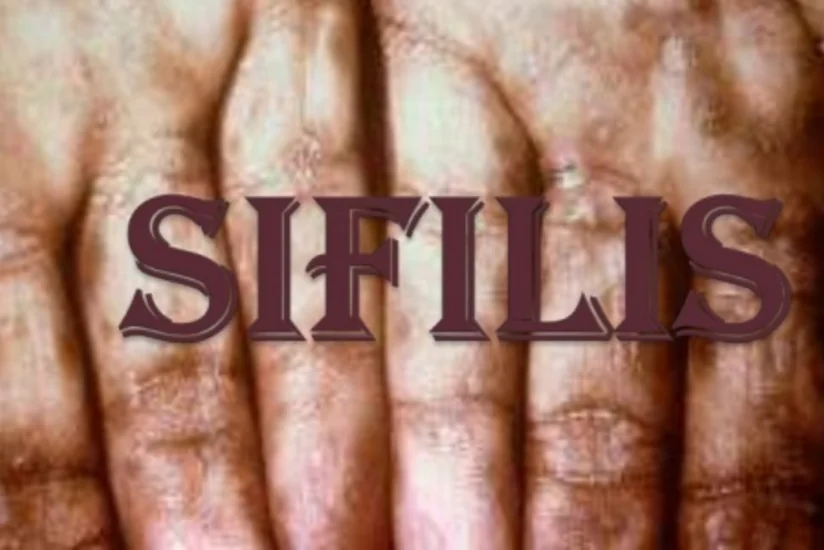 Azərbaycanda qeydiyyatda olan sifilis xəstələrinin əksəriyyəti kişilərdir