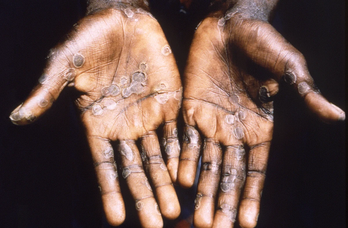 WHO reports 80 confirmed cases of monkeypox in 11 countries
