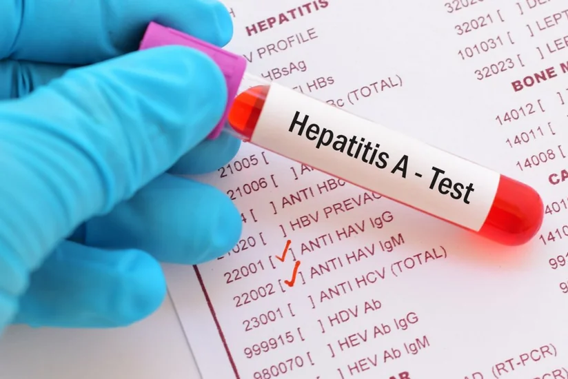 Azərbaycanda Hepatit A virusu ilə bağlı son vəziyyət açıqlanıb
