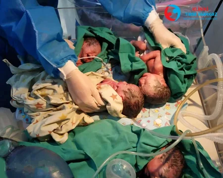Bakıda COVID-19-a yoluxan hamilələrdən biri üçəm, digəri dördəm dünyaya gətirib