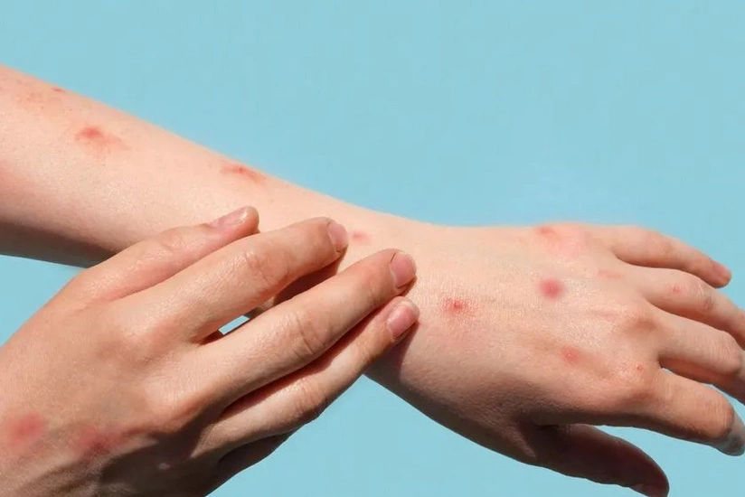 Kürdəmirdə 7 məktəbdə şagirdlər arasında qızılca yayılıb