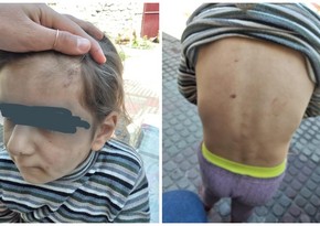 Azyaşlı qızın atalığı tərəfindən döyülməsilə bağlı araşdırmalara başlanıldı
