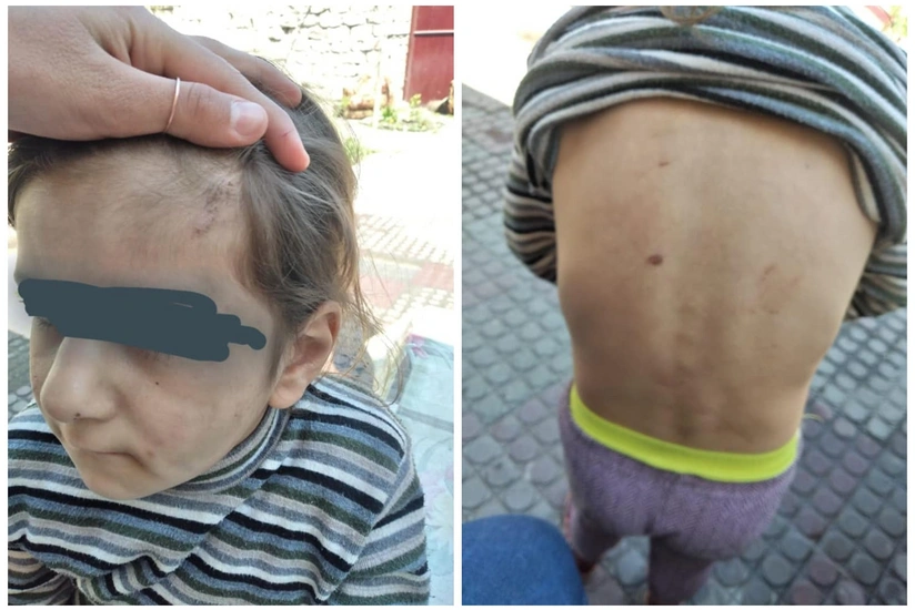 Azyaşlı qızın atalığı tərəfindən döyülməsilə bağlı araşdırmalara başlanıldı