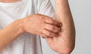 Alimlər hər il 11 milyon insanı öldürən infeksiyanı dayandıra bilən anticisim yaradıblar
