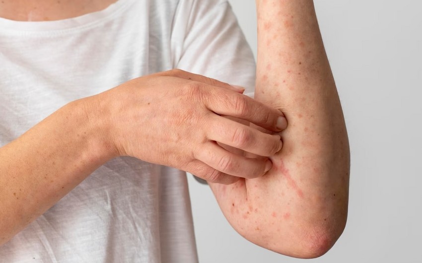 Alimlər hər il 11 milyon insanı öldürən infeksiyanı dayandıra bilən anticisim yaradıblar