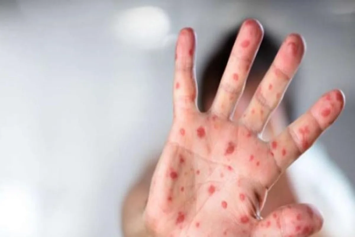 SN: Bəzi bölgələrdə qızılcaya yoluxma halları müşahidə edilib, epidemioloji vəziyyət stabildir