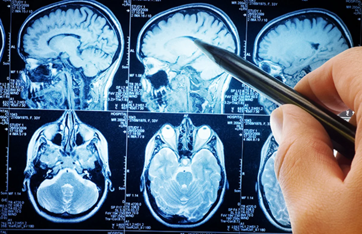 Scientists discover cellular hotspots in brain signifying earliest signs of cancer