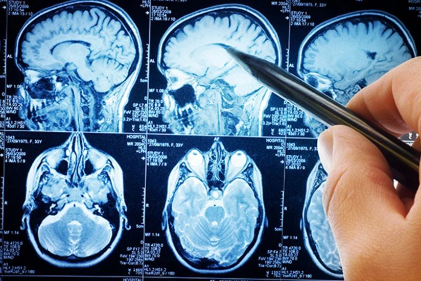 Scientists discover cellular hotspots in brain signifying earliest signs of cancer