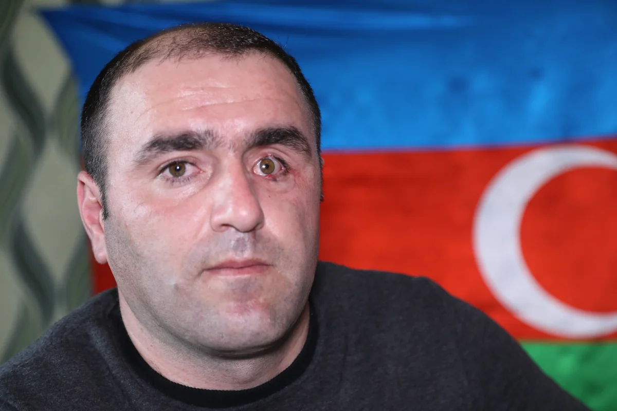 Gözündən əməliyyat olunan qazimizə protez qoyulub - VİDEO