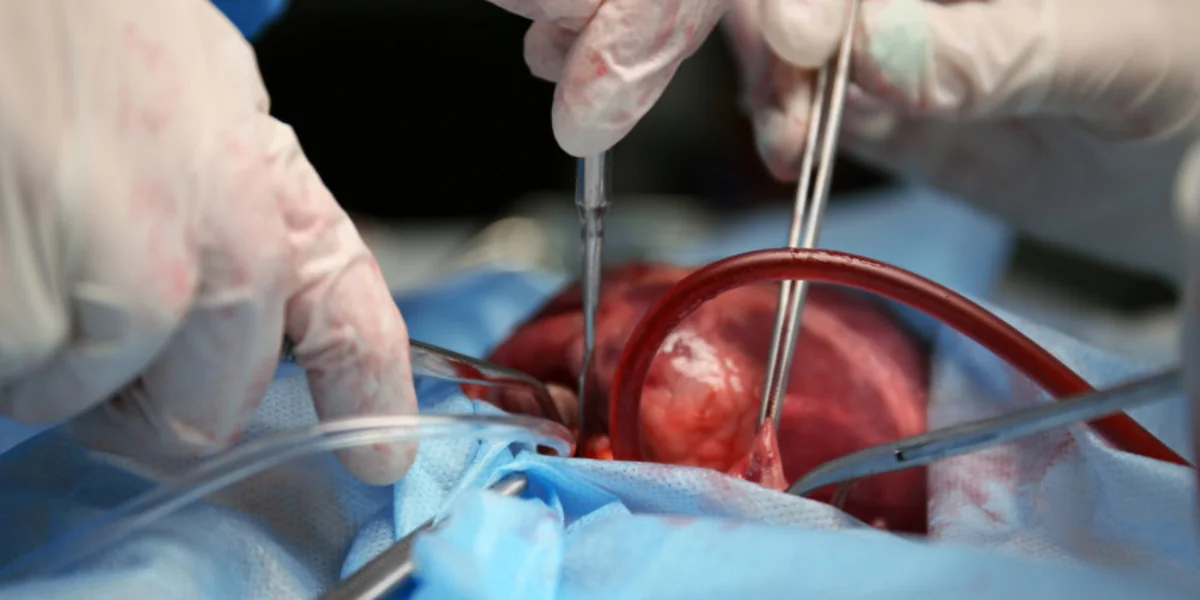 Ağciyər və qaraciyərin transplantasiyası metodu ilə müalicə zərurətinin təcililik statusuna dair meyarlar açıqlanıb
