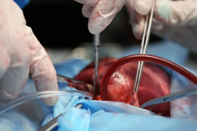 Ağciyər və qaraciyərin transplantasiyası metodu ilə müalicə zərurətinin təcililik statusuna dair meyarlar açıqlanıb