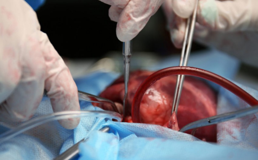 Ağciyər və qaraciyərin transplantasiyası metodu ilə müalicə zərurətinin təcililik statusuna dair meyarlar açıqlanıb