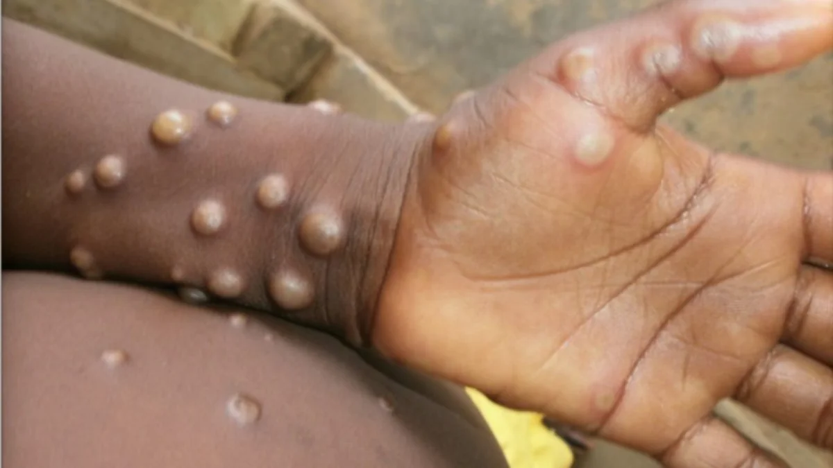 Huge rise in monkey pox cases in DR Congo: Gov't