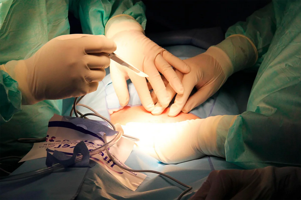 Surgeons transplant pig lung into brain dead human recipient for first time