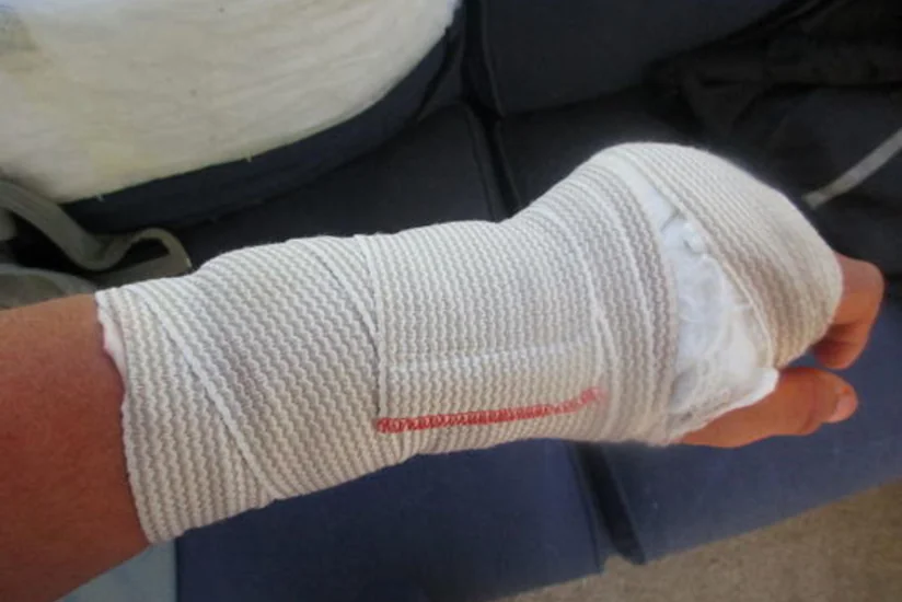 Bakıda yol qəzasında kişinin qolu sındı