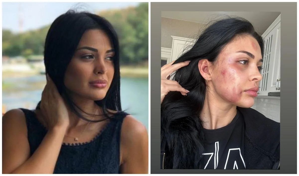 Bakıda modeli döyməkdə şübhəli bilinən şəxs həbs edilib