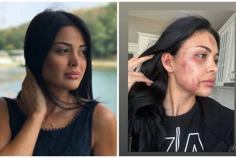 Bakıda modeli döyməkdə şübhəli bilinən şəxs həbs edilib