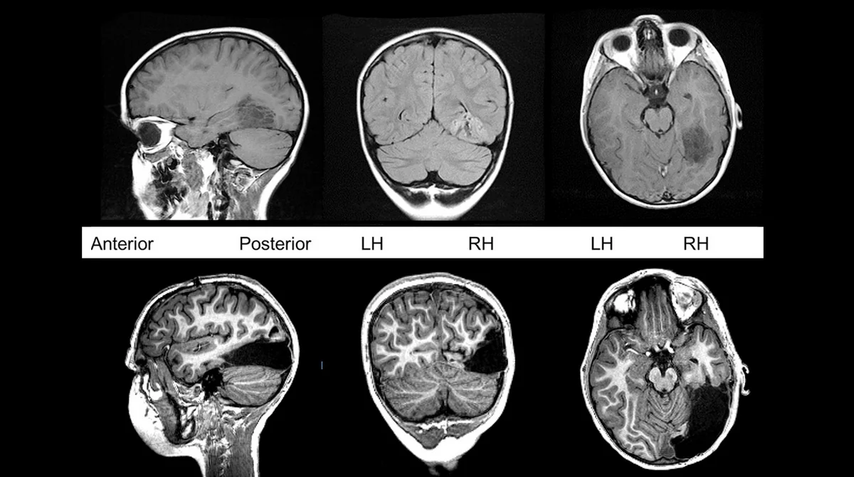 Выявлен новый тип шизофрении - ФОТО